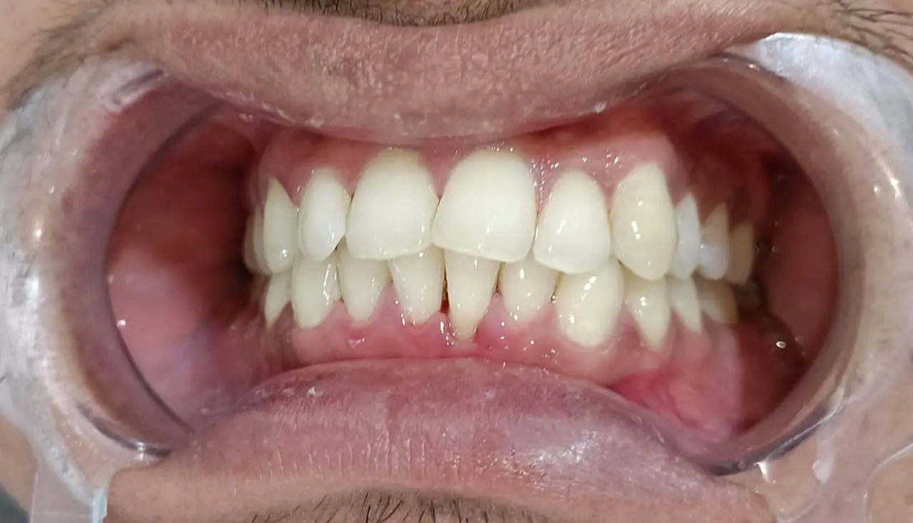 Before and after teeth cleaning example 2