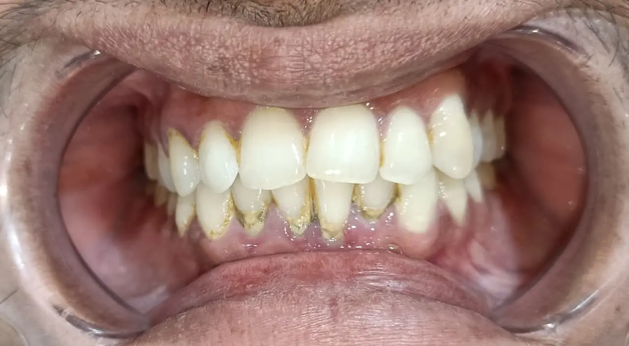 Before and after teeth cleaning example 1