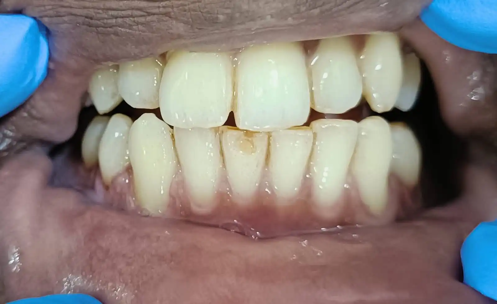 Before and after teeth cleaning example 2