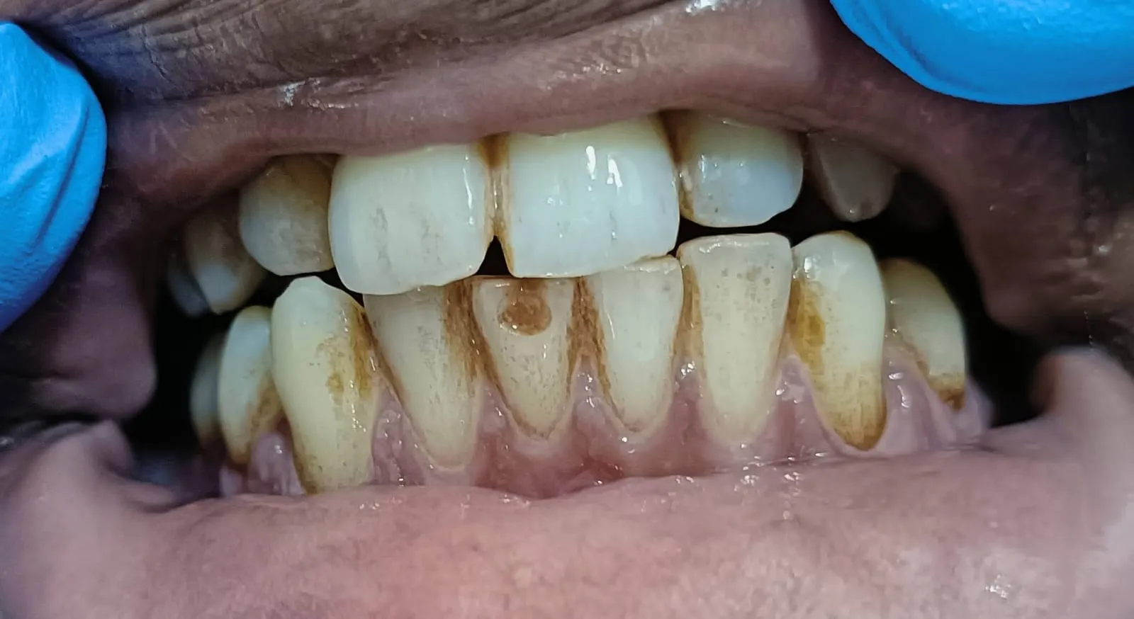 Before and after teeth cleaning example 1