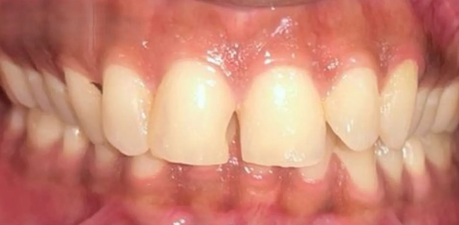 Before and after cosmetic dentistry example 1