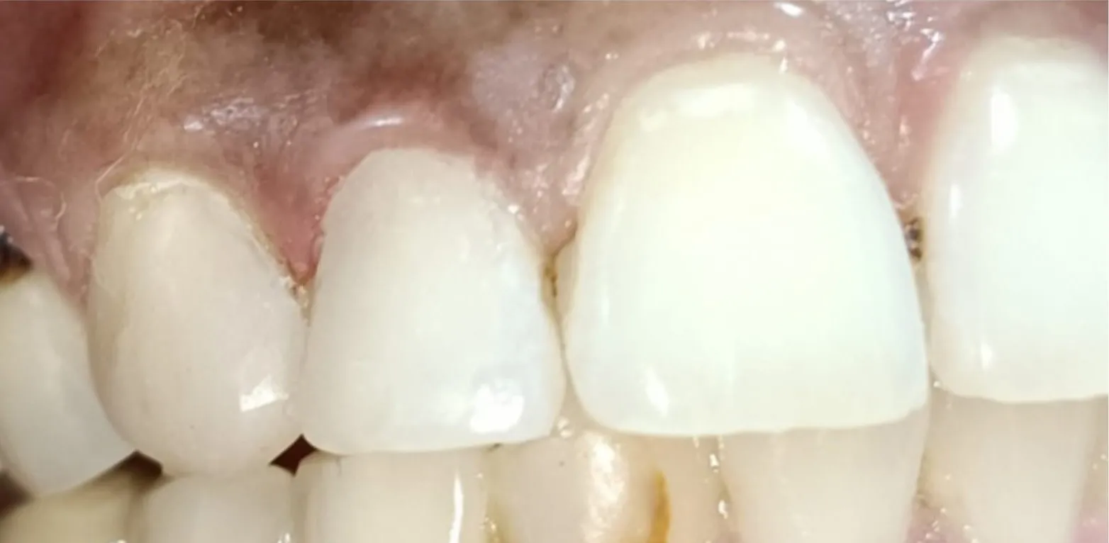 Before and after Cosmetic Dentistry example 2