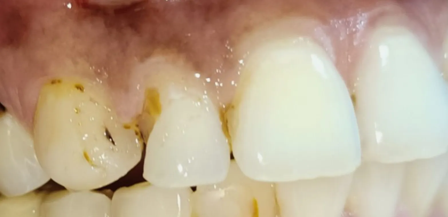 Before and after Cosmetic Dentistry example 1