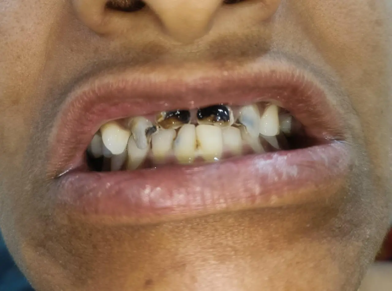 Before and after Crown and bridges example 1