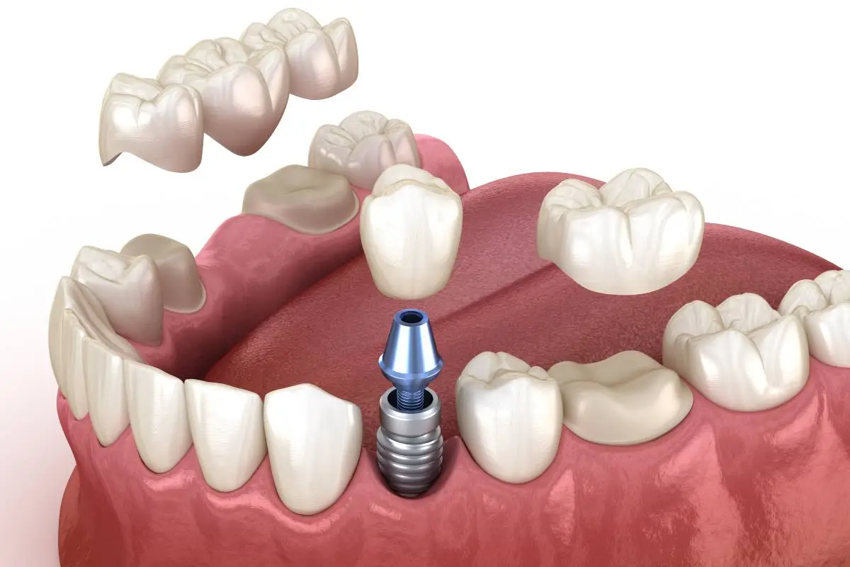 Dental crowns and bridges restoration