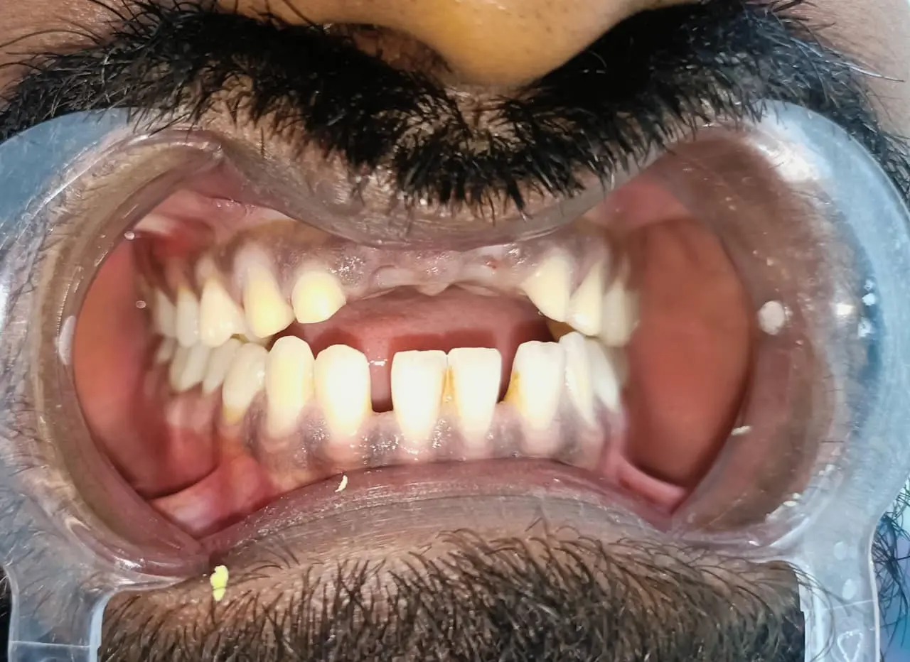 Before and after Crown and bridges example 1
