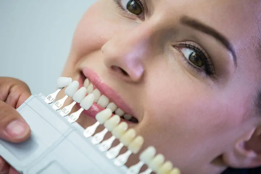 Porcelain veneers smile transformation