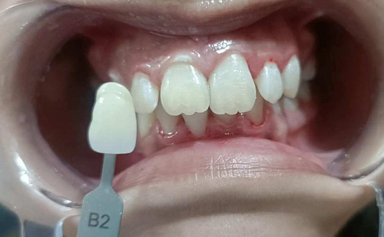 Before and after teeth whitening example 2