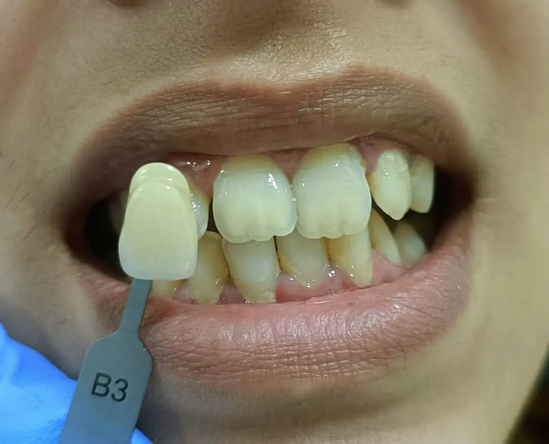 Before and after teeth whitening example 1