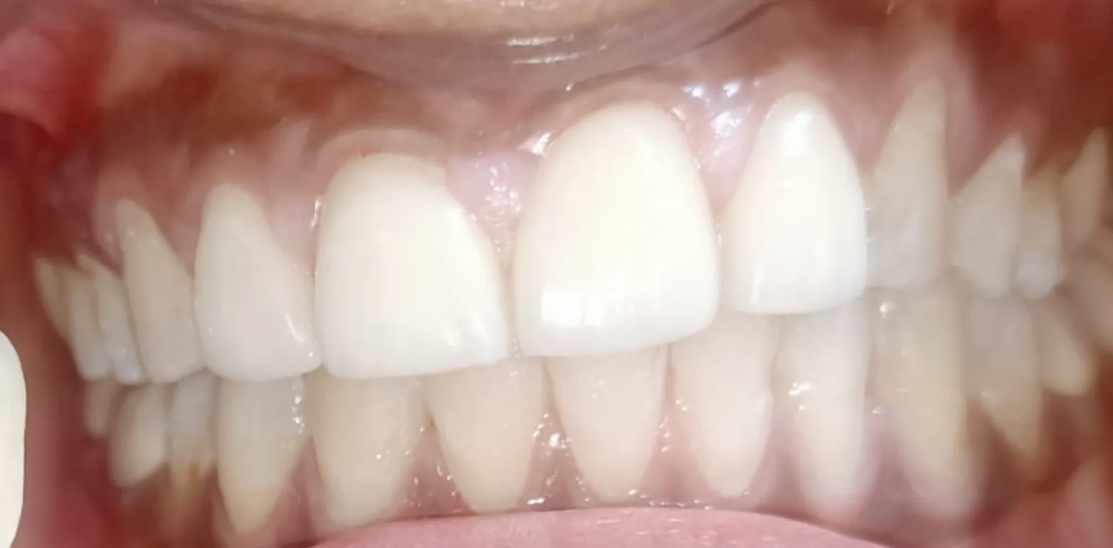 Before and after Teeth Whitening example 2