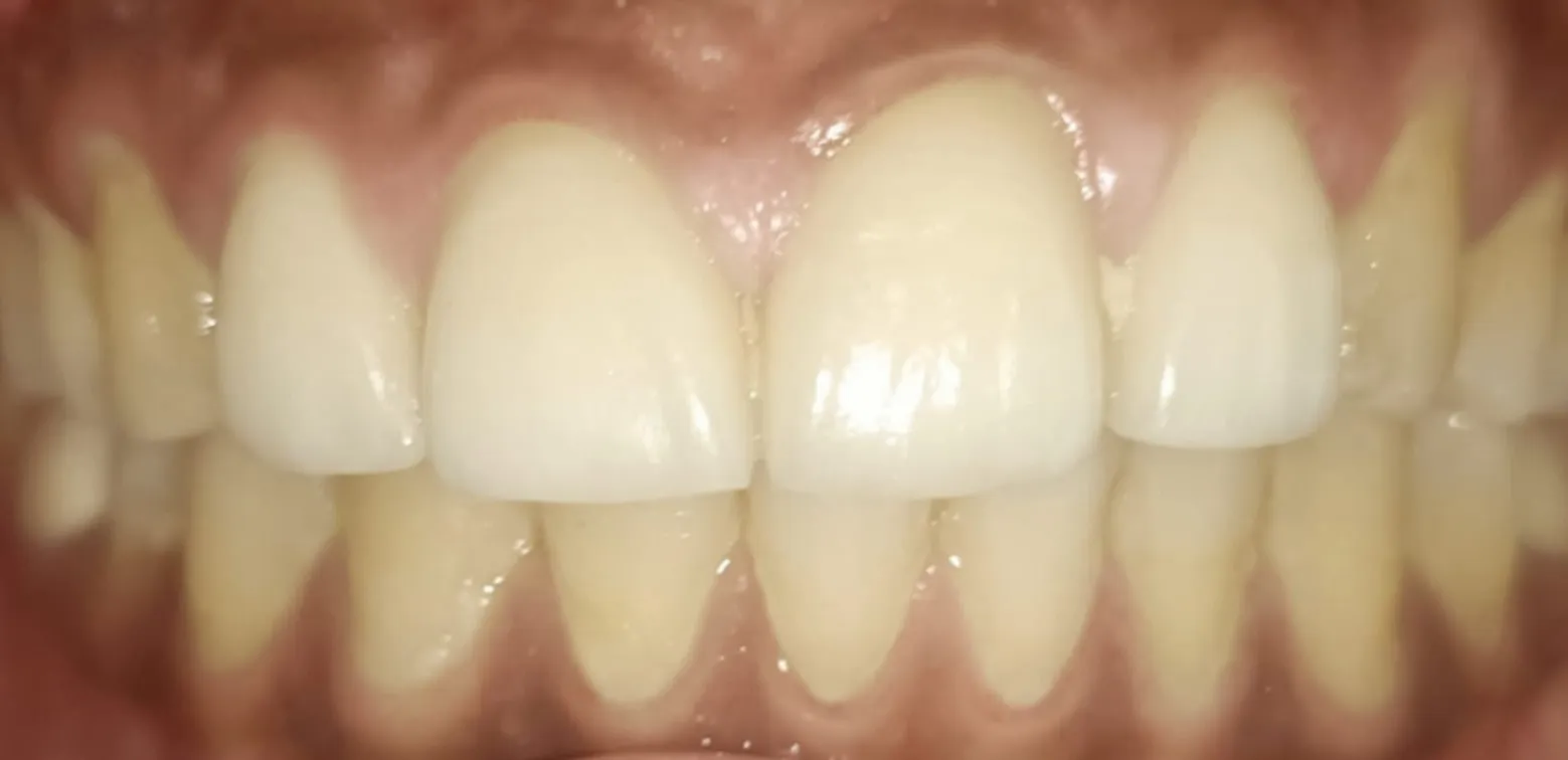 Before and after Teeth Whitening example 1